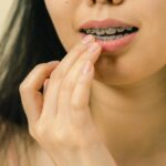 Quelle hygiène dentaire pour éviter les aphtes ?